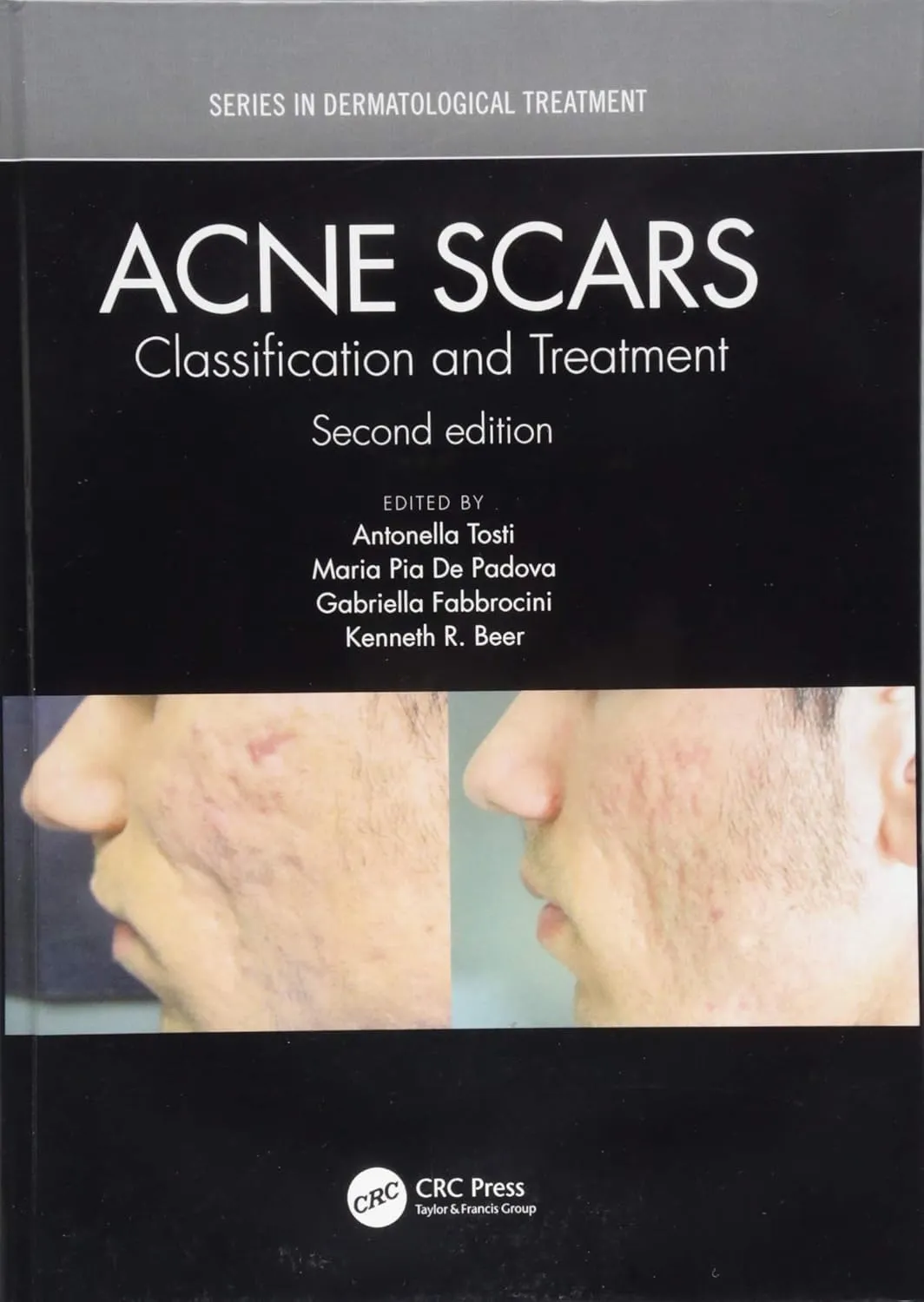 ACNE Scars Classification and Treatment | 2nd Edition | Hardcover