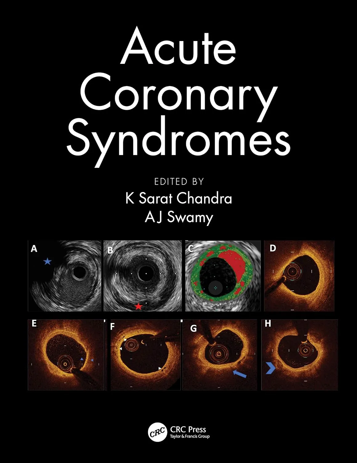 Acute Coronary Syndromes | Paperback