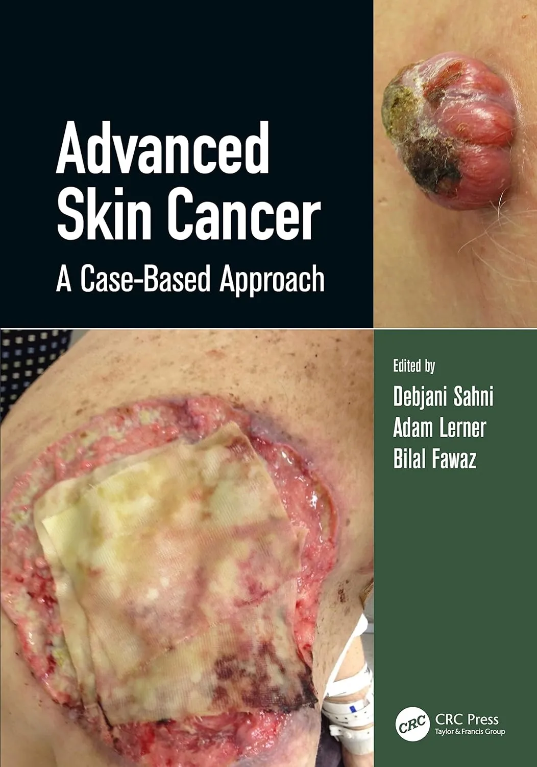 Advanced Skin Cancer A Case Based Approach | Hardcover
