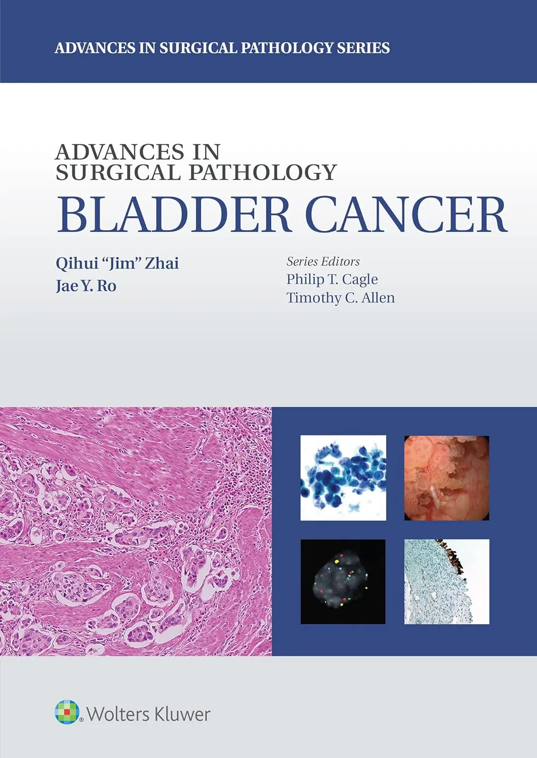 Advances in Surgical Pathology Bladder Cancer | Hardcover
