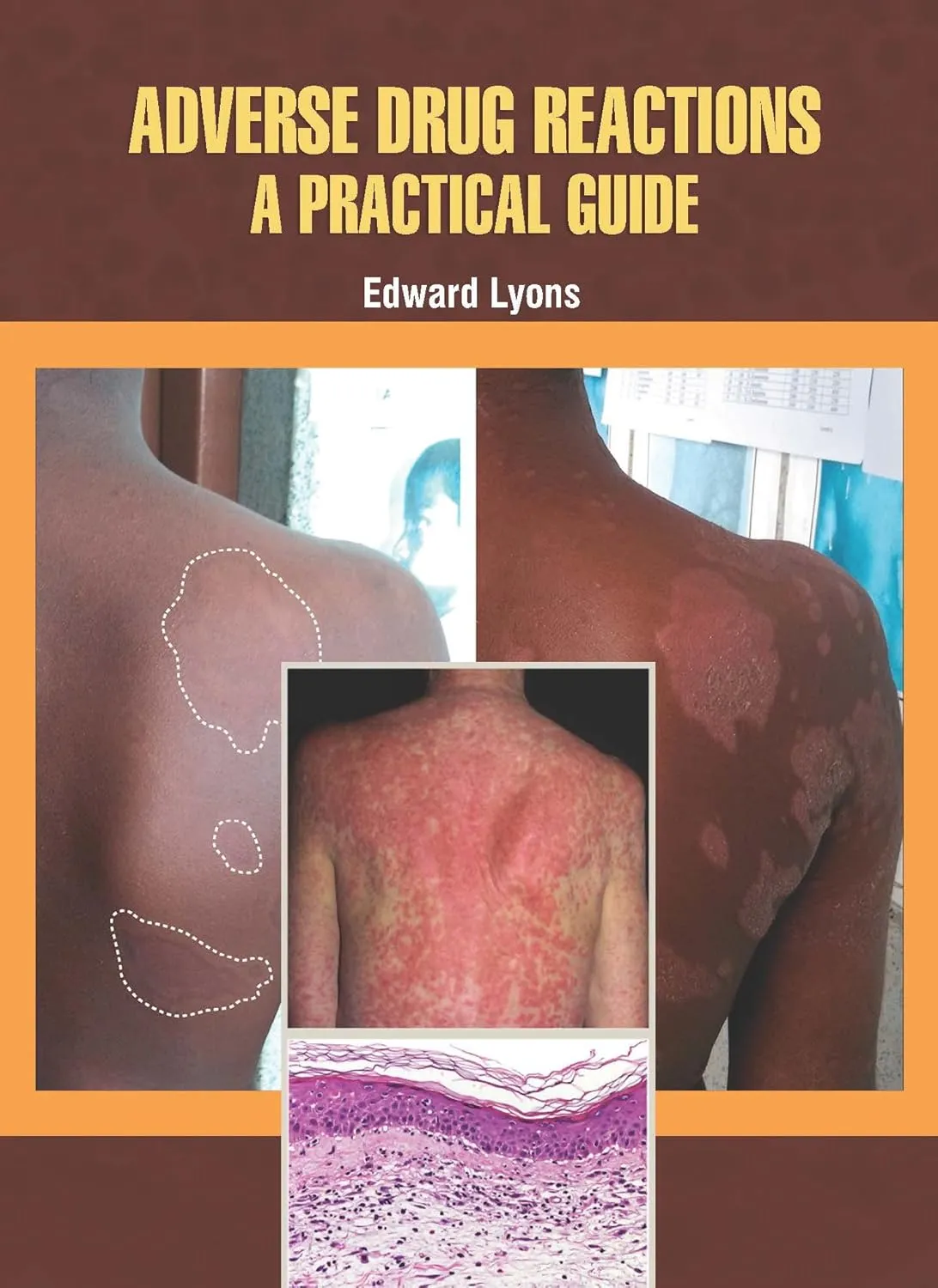Adverse Drug Reactions A Practical Guide | Hardcover