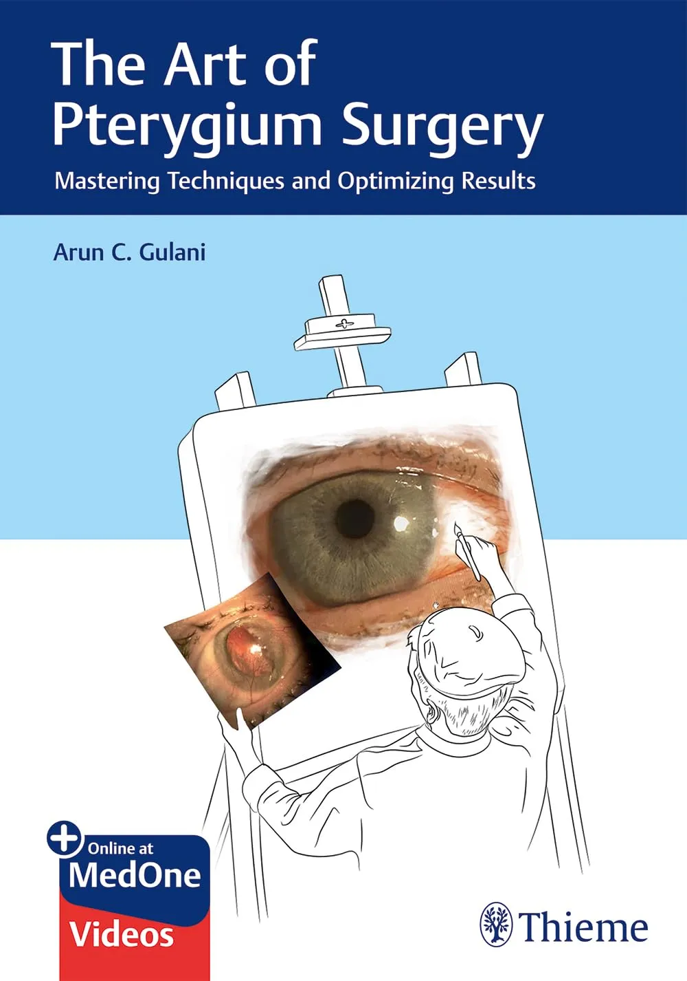 The Art of Pterygium Surgery Mastering Techniques and Optimizing Results | Hardcover