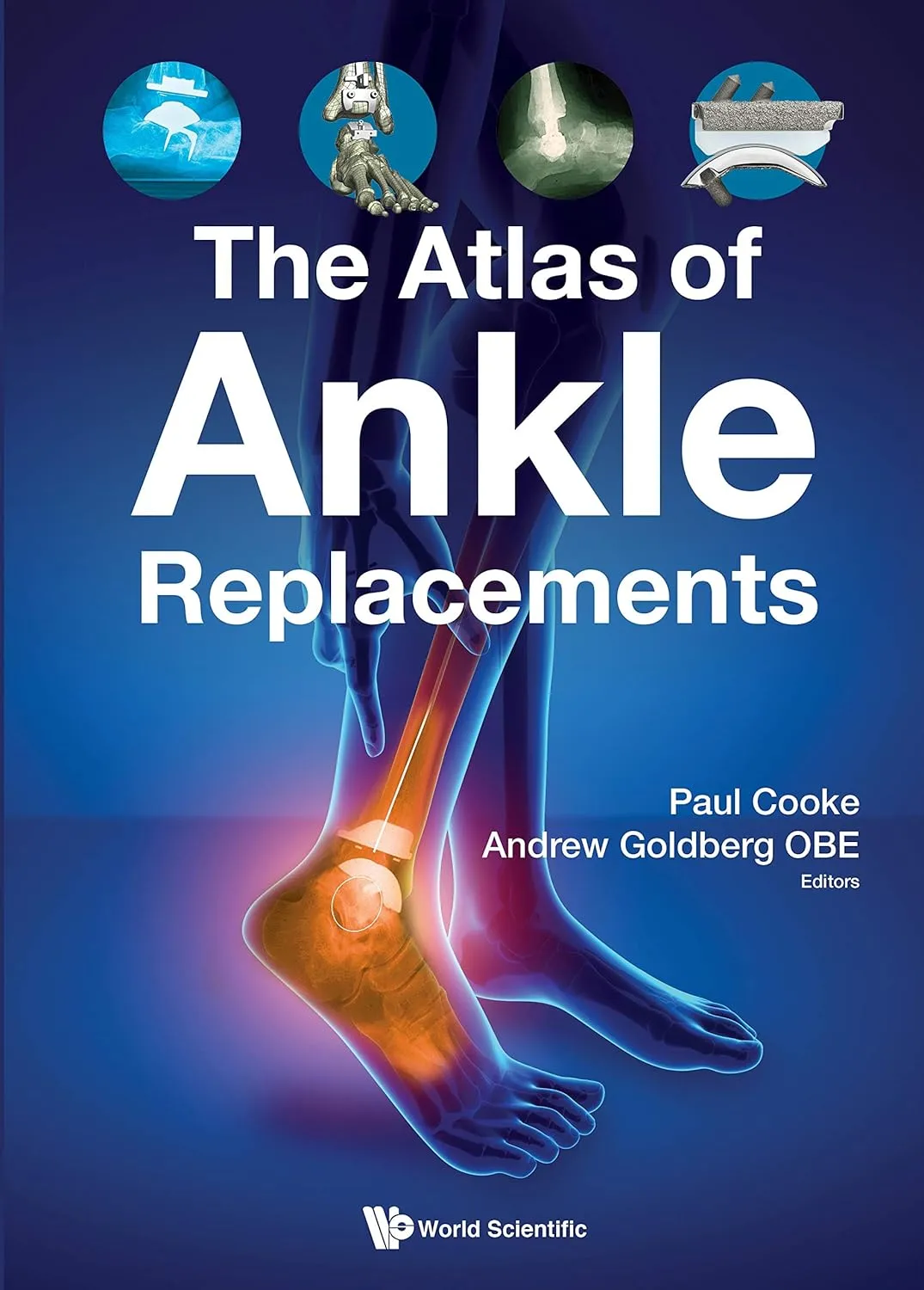 The Atlas Of Ankle Replacements | Paperback