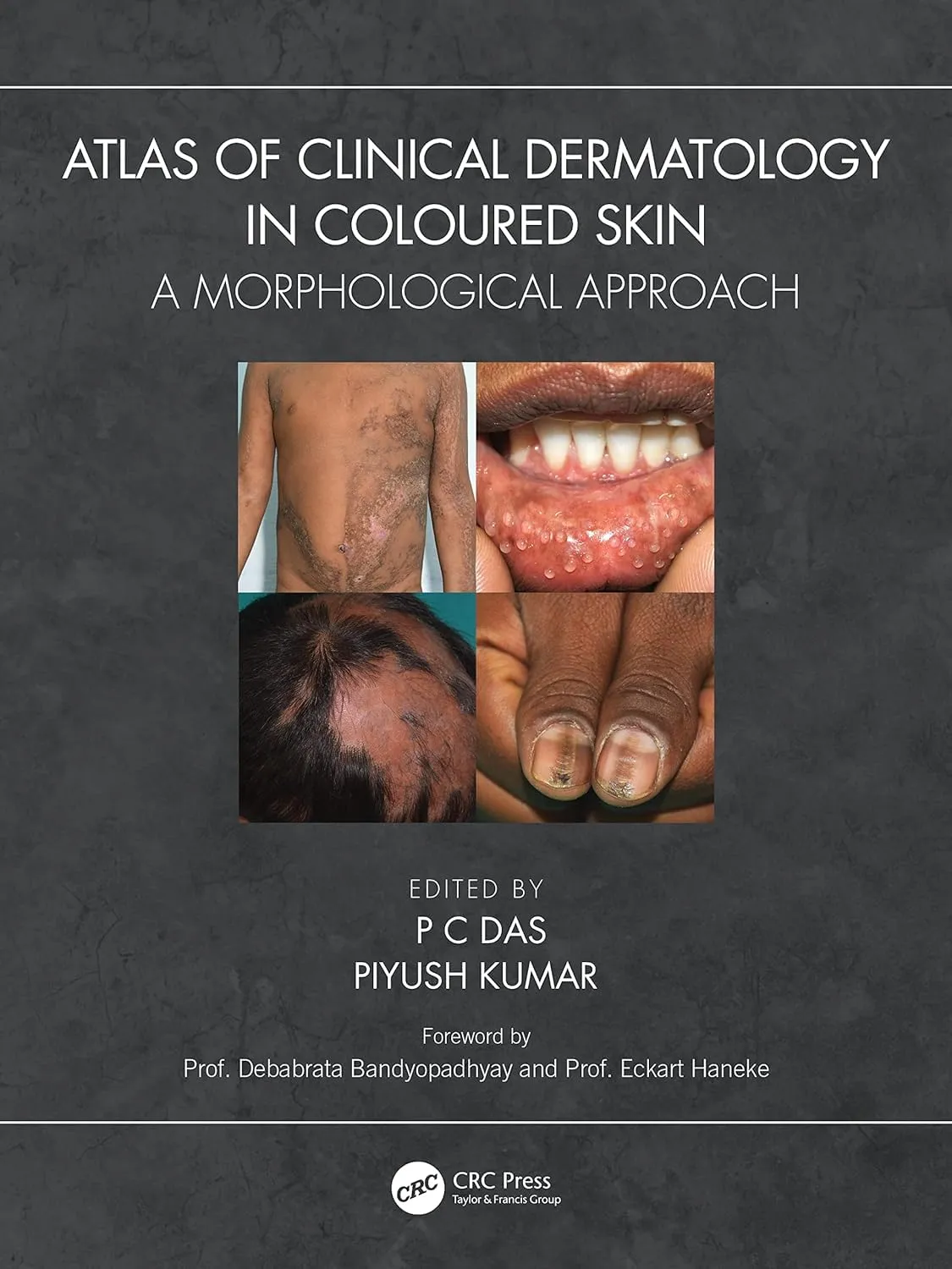 Atlas Of Clinical Dermatology In Coloured Skin A Morphological Approach | Paperback