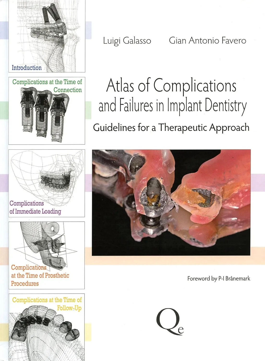 Atlas of Complications and Failures in Implant Dentistry | Hardcover