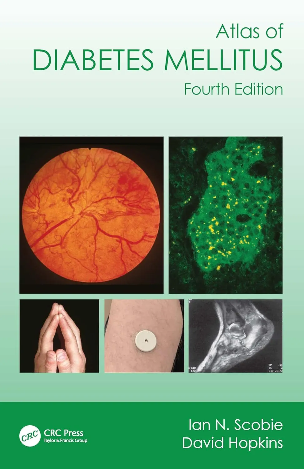 Atlas Of Diabetes Mellitus 4th Edition | Paperback