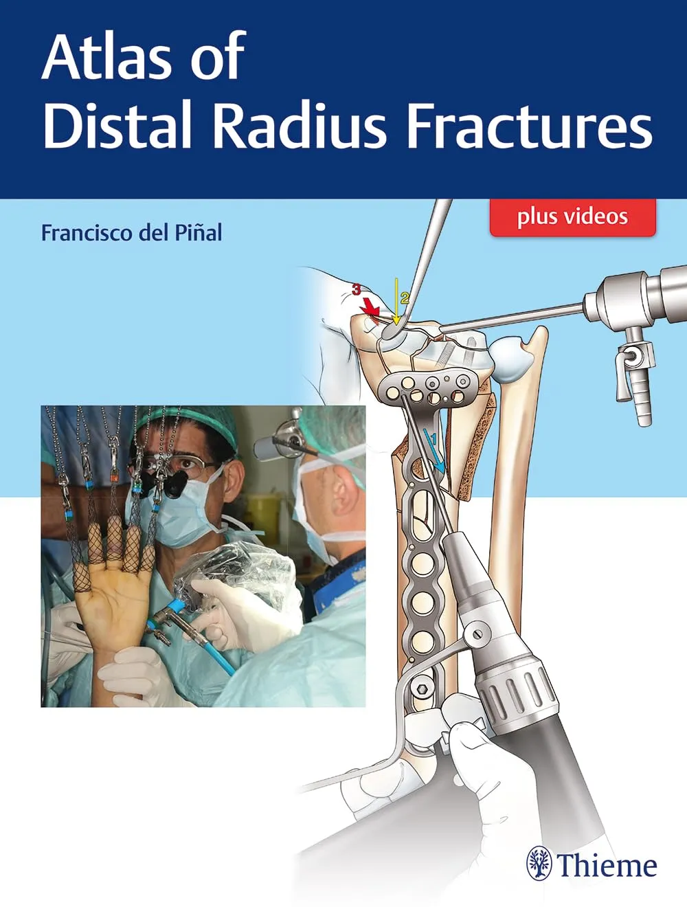 Atlas of Distal Radius Fractures | Hardcover