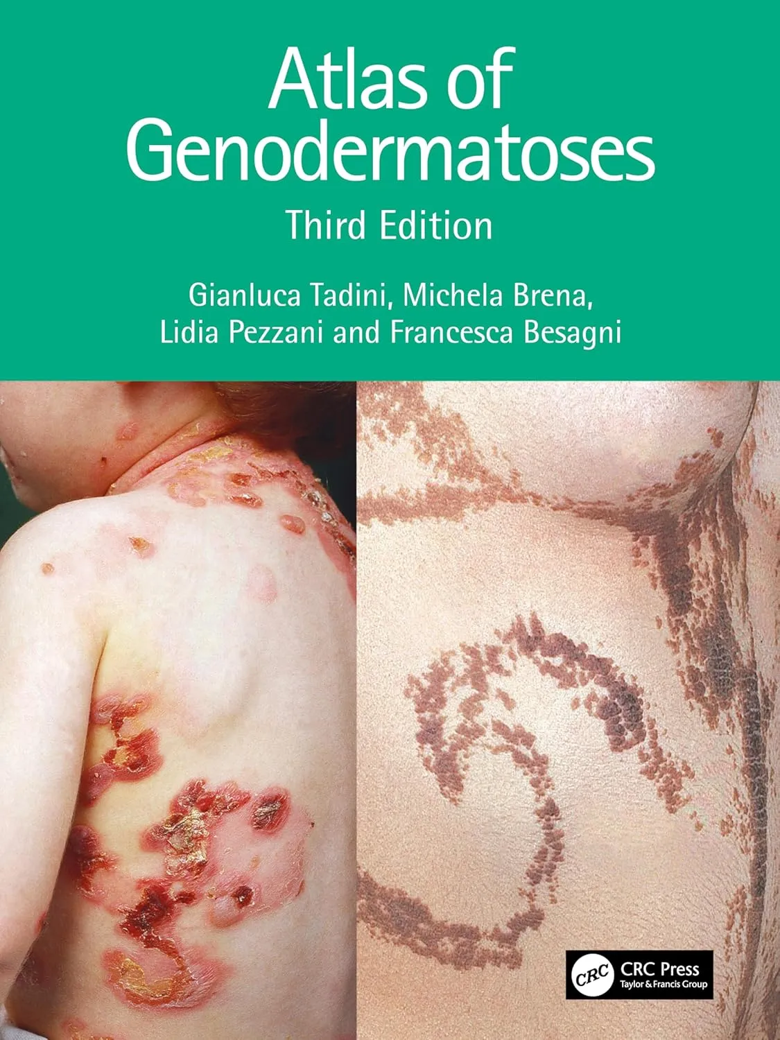 Atlas Of Genodermatoses Third Editiond | Paperback