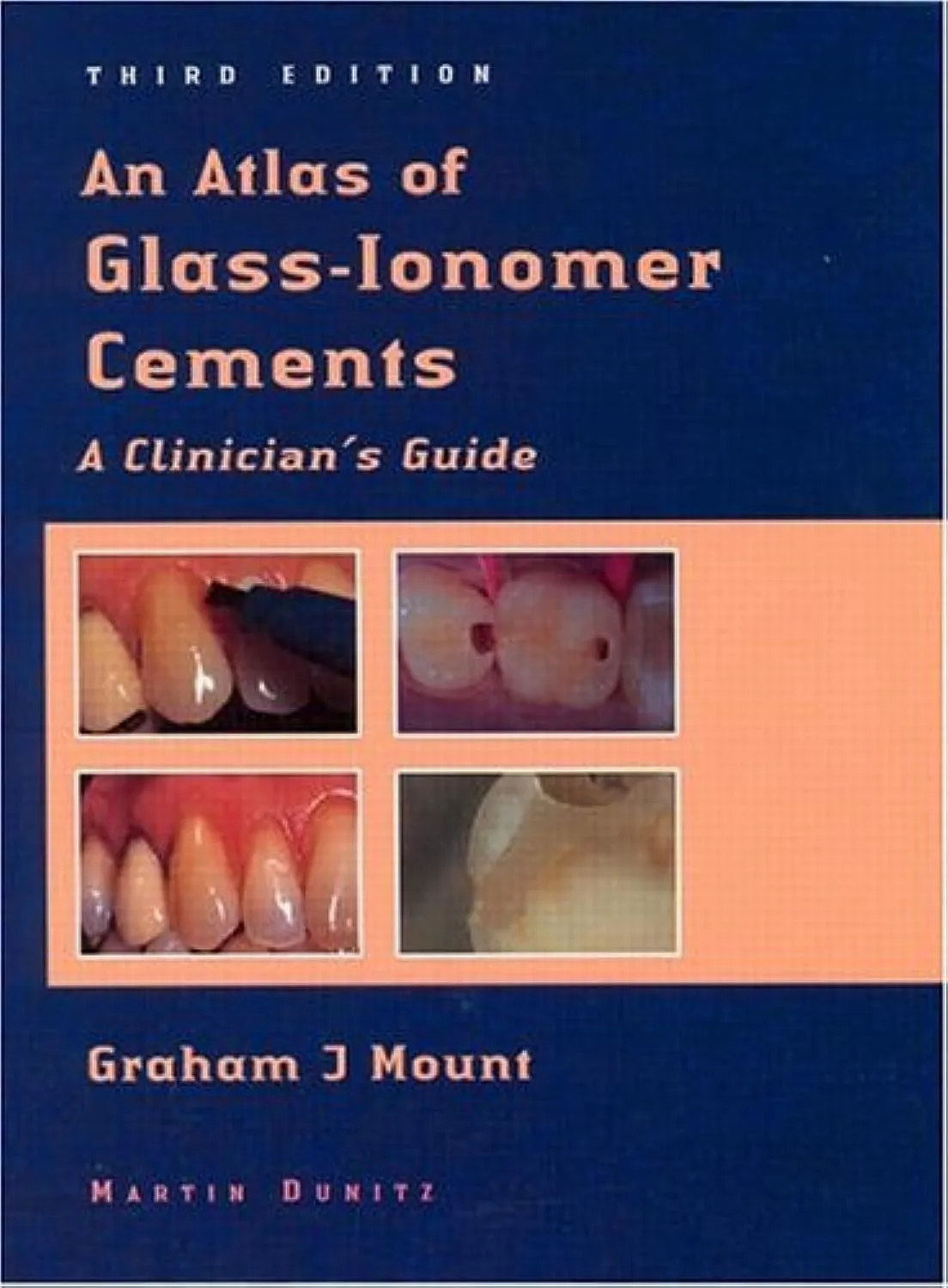 An Atlas of Glass-Ionomer Cements Alinicians Guide | Hardcover