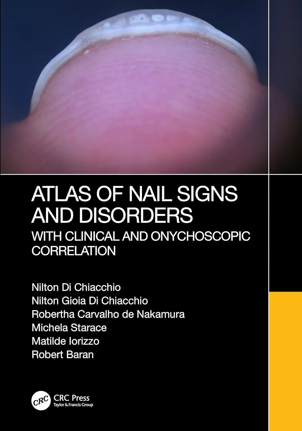 Atlas Of Nail Signs And Disorders With Clinical And Onychoscopic Correlation | Hardcover
