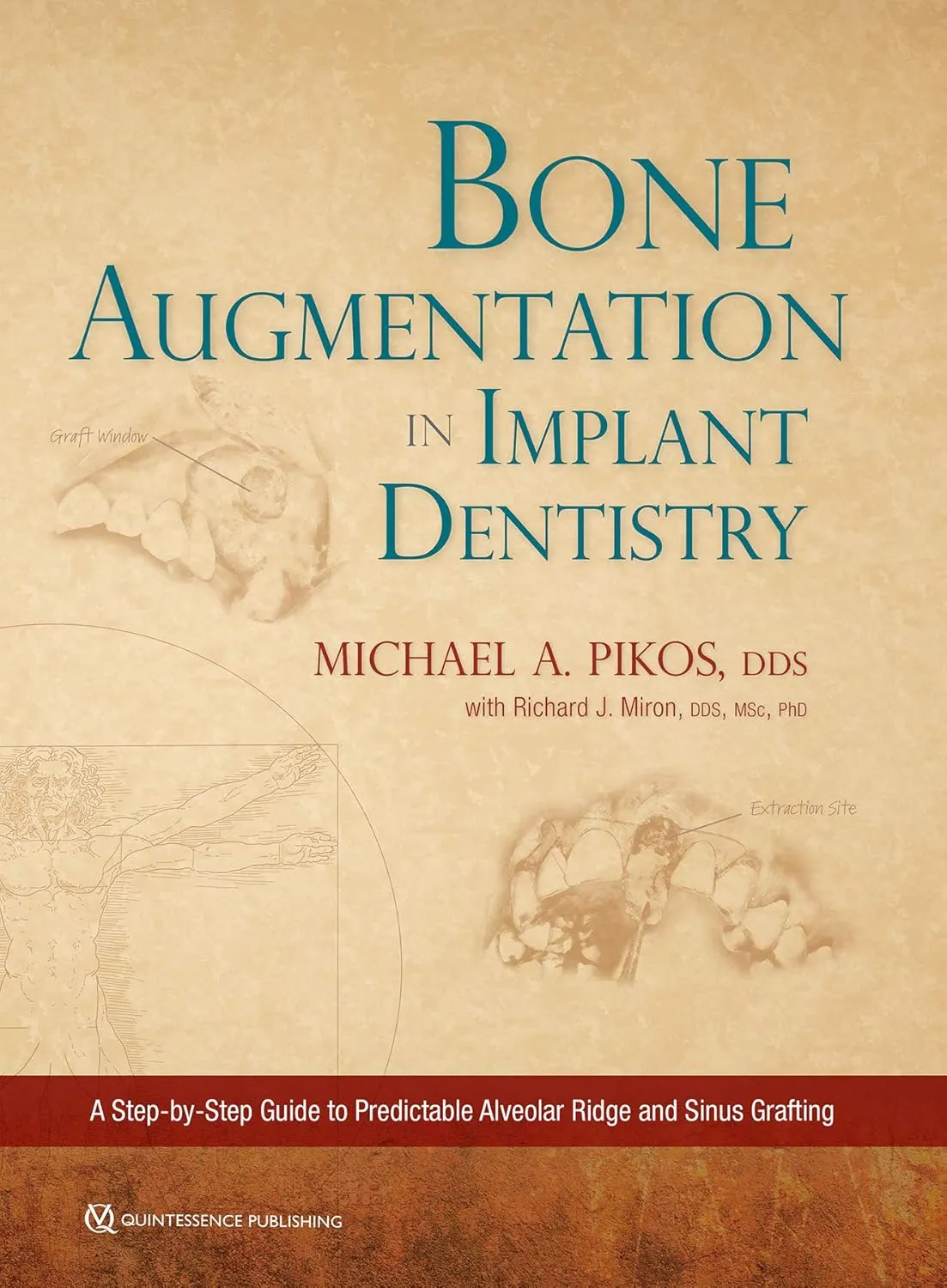 Bone Augmentation in Implant Dentistry | Hardcover