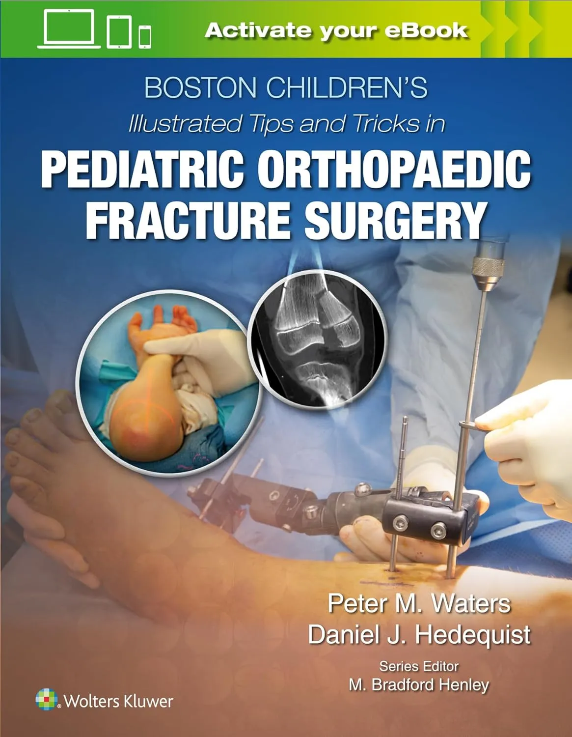 Boston Children's Illustrated Tips and Tricks in Pediatric Orthopaedic Fracture Surgery | Hardcover