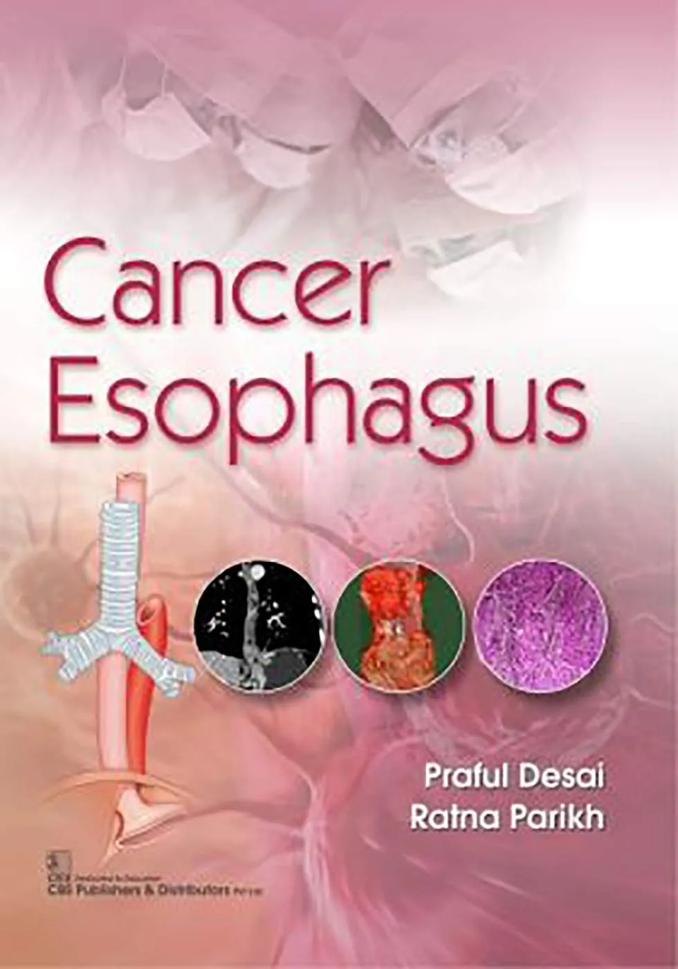 Cancer Esophagus | Paperback