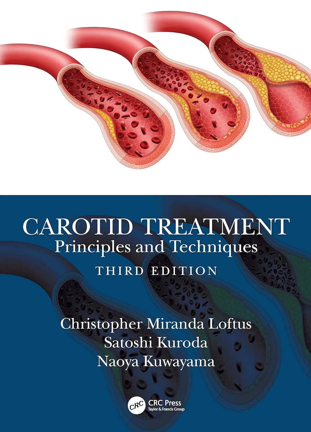 Carotid Treatment Principles And Techniques | Third Edition | Hardcover