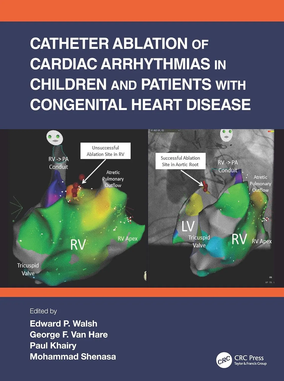 Catheter Ablation Of Cardiac Arrhythmias In Children And Pathients With Congenital Heart Disease | Paperback