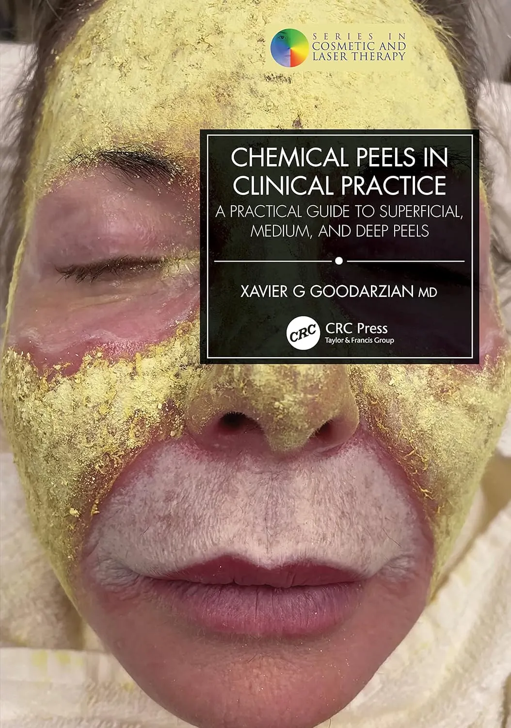 Chemical Peels In Clinical Practice A Practical Guide To Superficial Medium And Deep Peels | Paperback