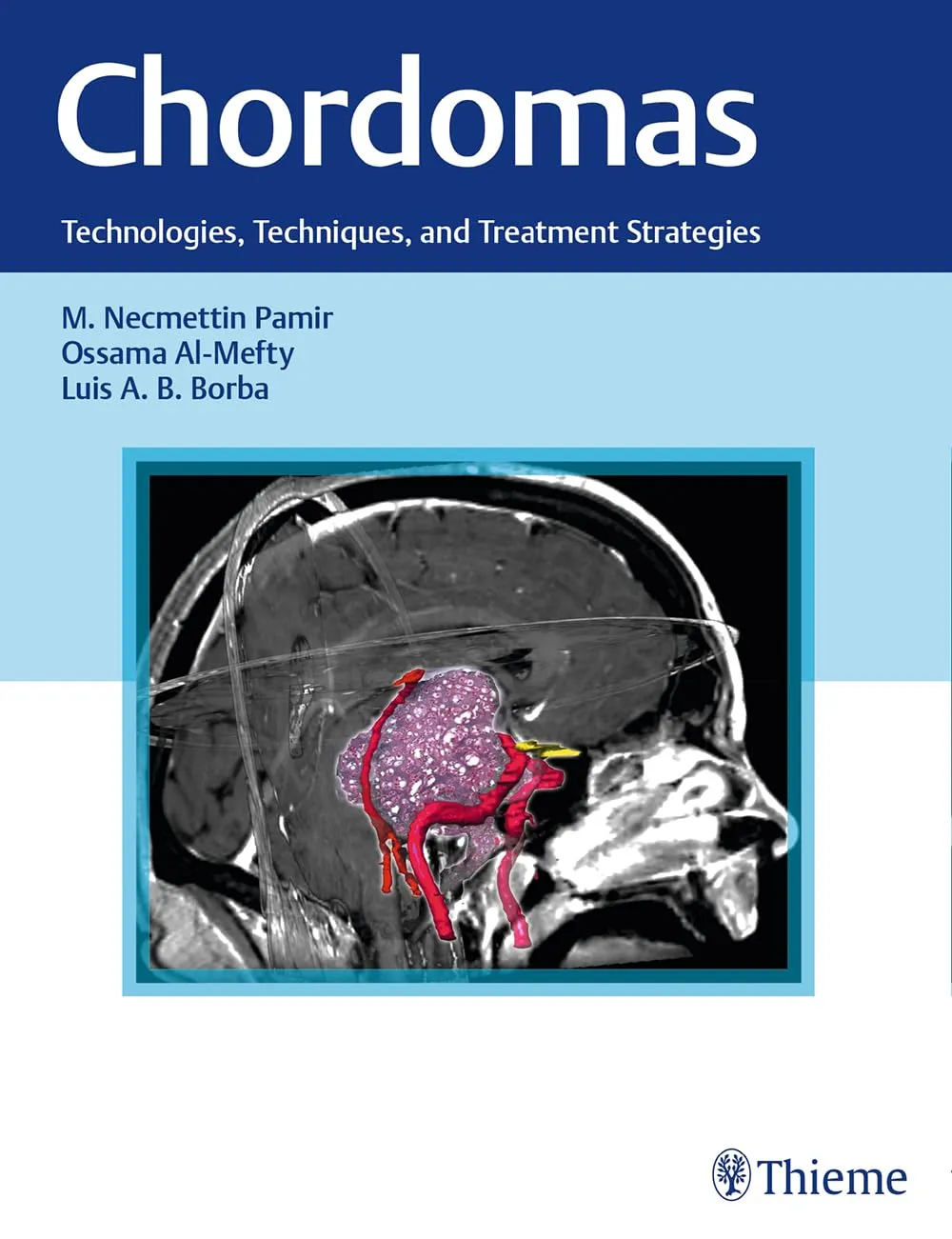 Chordomas Technologies | Techniques | and Treatment Strategies | Hardcover