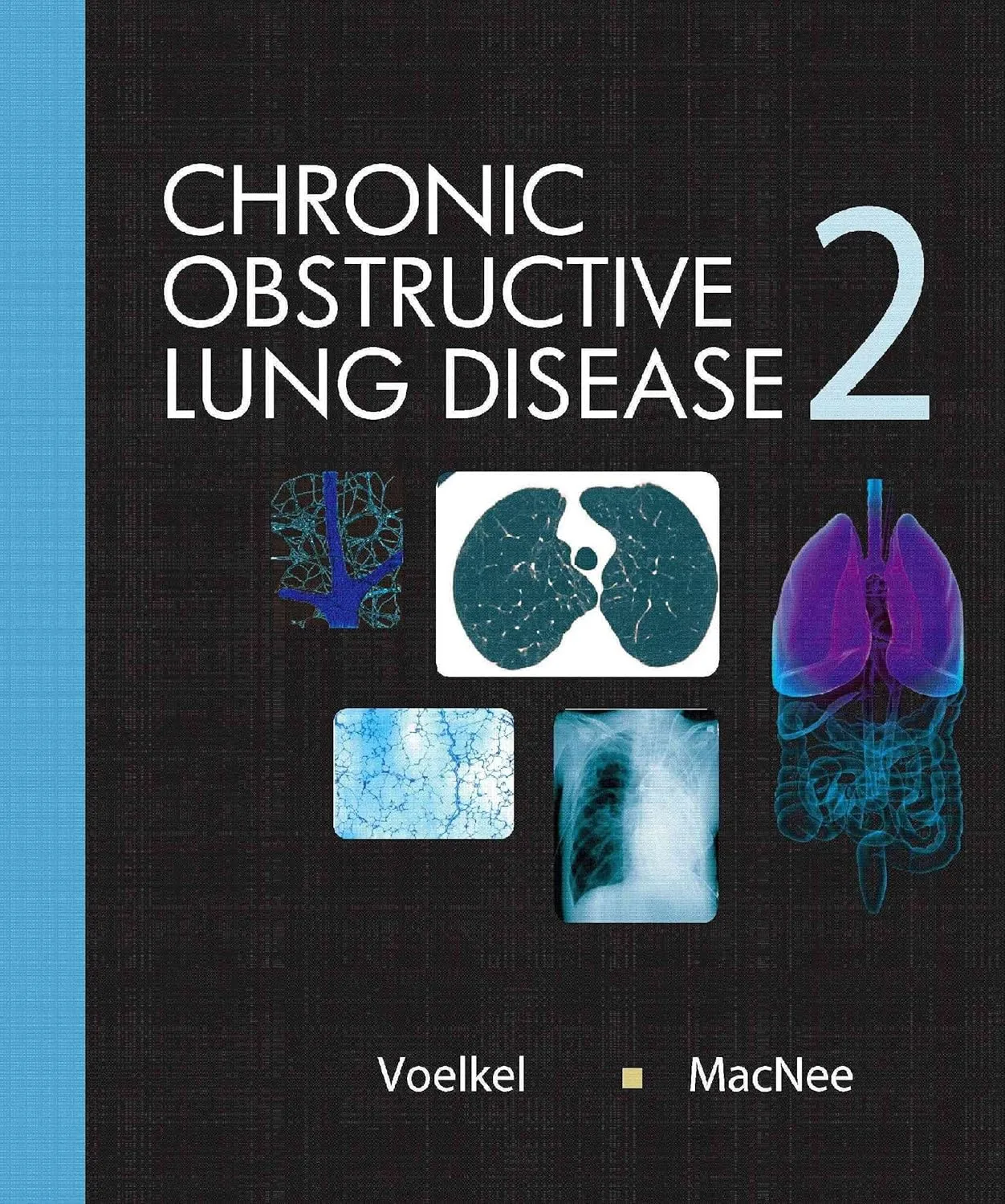 Chronic Obstructive Lung Diseases | 2nd Edition | Hardcover