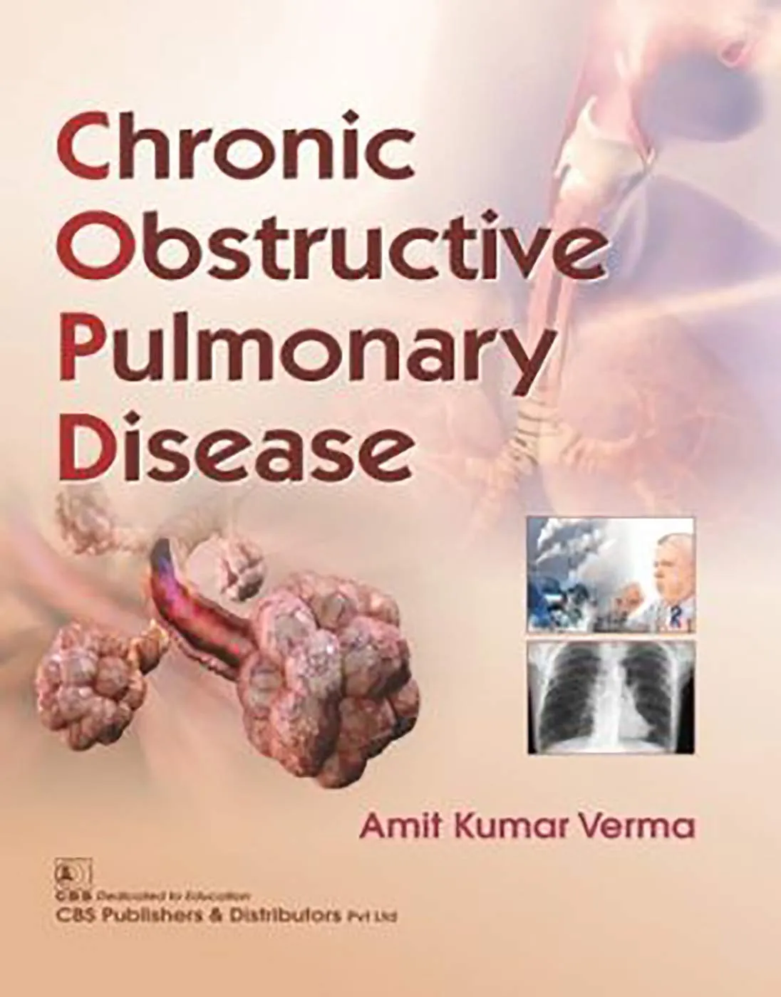 Chronic Obstructive Pulmonary Disease | Paperback