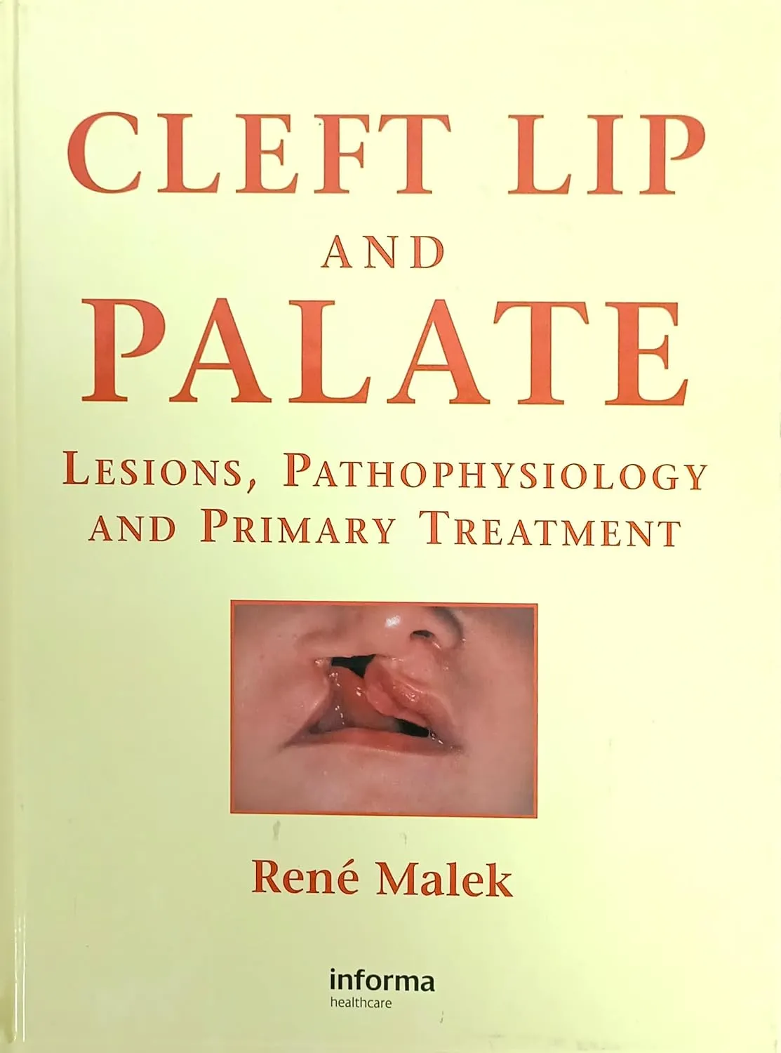 Cleft Lip and Palate Lessions | Pathophysiology and Primary Treatment | Hardcover