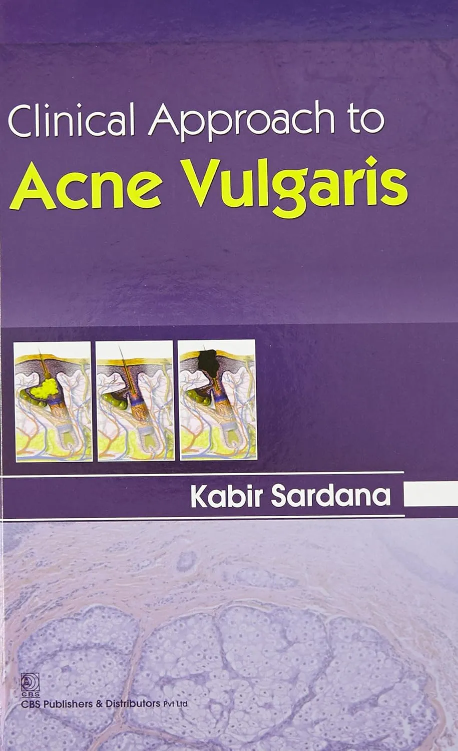 Clinical Approach to Acne Vulgaris