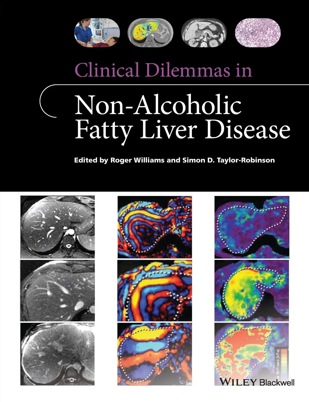 Clinical Dilemmas in Non-Alcoholic Fatty Liver Disease | Paperback