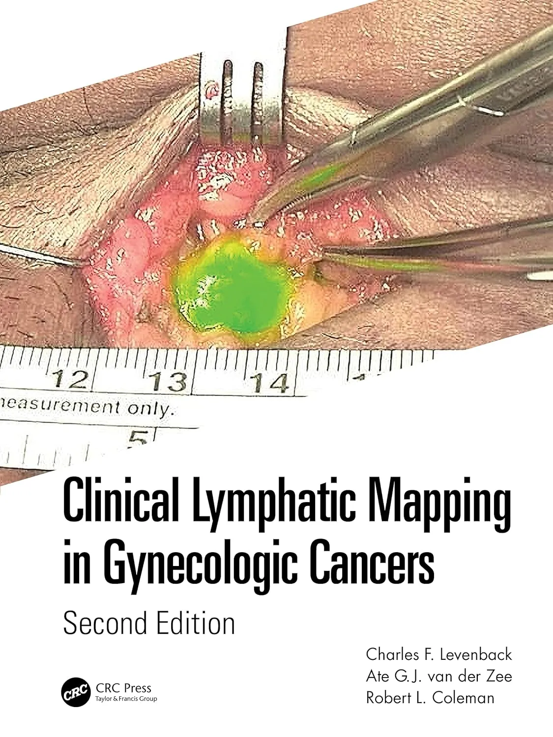 Clinical Lymphatic Mapping In Gynecologic Cancers 2nd Edition | Hardcover