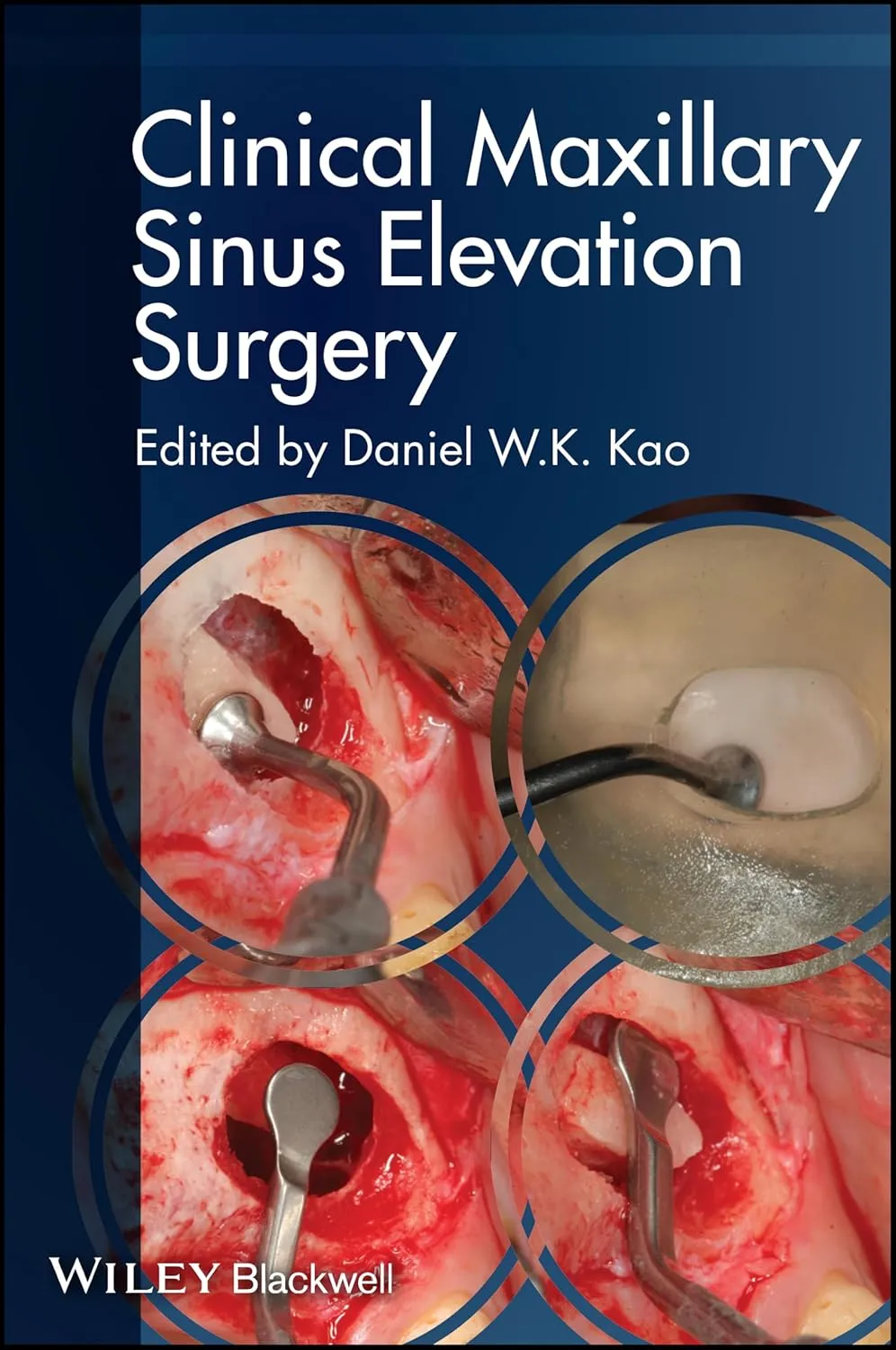 Clinical Maxillary Sinus Elevation Surgery | Paperback