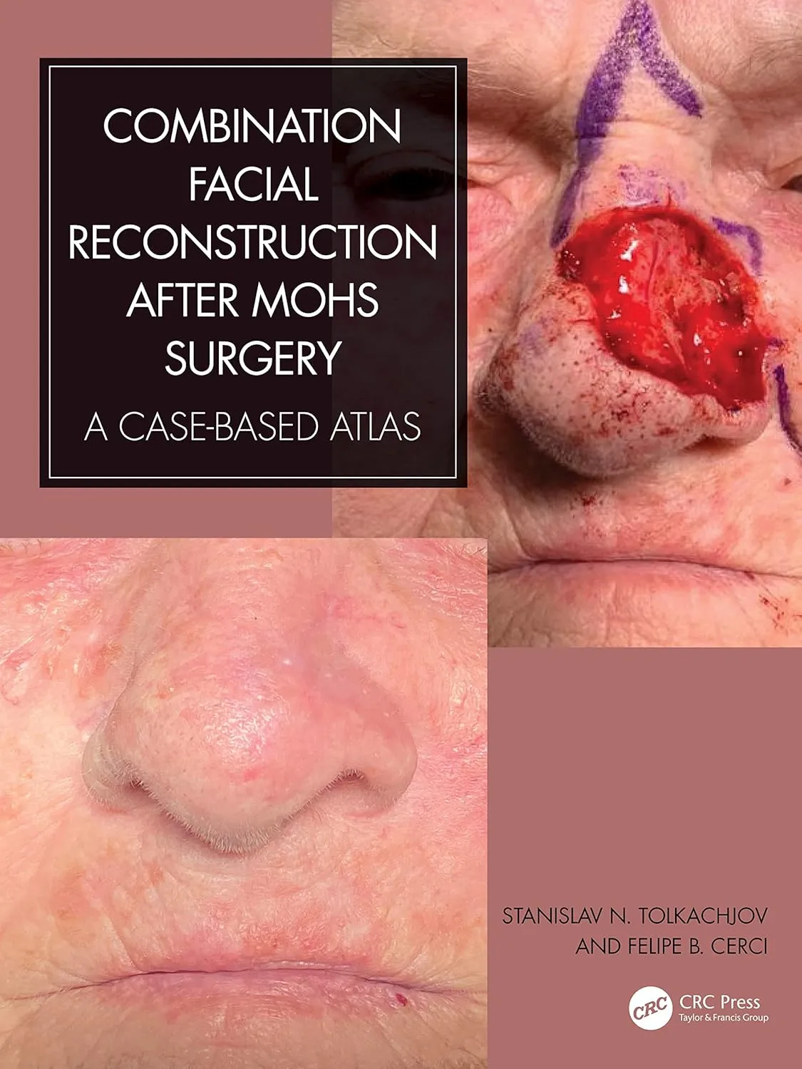 Combination Facial Reconstruction After Mohs Surgery A Case Based Atlas | Hardcover