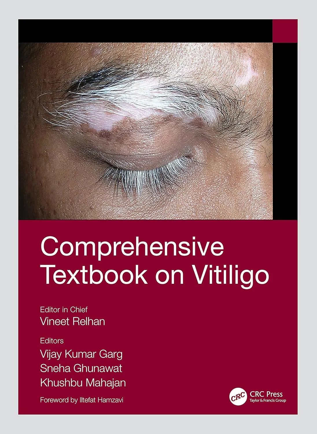 Comprehensive Textbook On Vitiligo | Hardcover