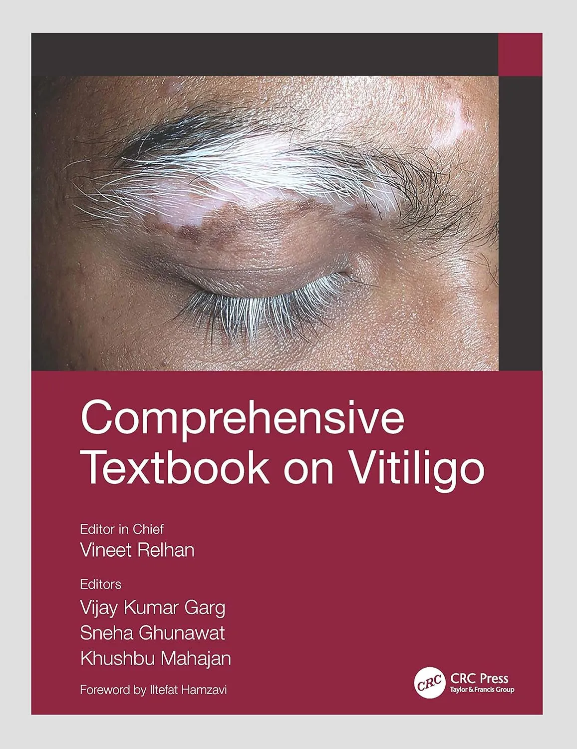 Comprehensive Textbook On Vitiligo | Paperback