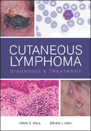 Cutaneous Lymphoma Diagnosis and Treatmnet | Hardcover
