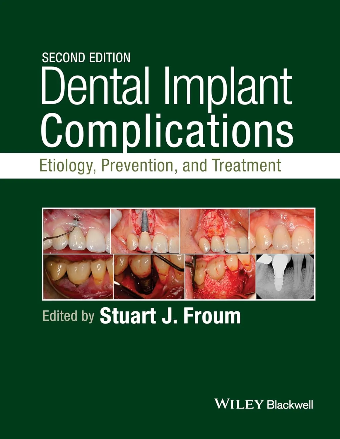 Dental Implant Complications Etiology | Prevention | and Treatment | 2nd Edition | Hardcover