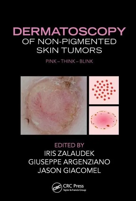 Dermatosocopy Of Non Pigmented Skin Tumors | Hardcover