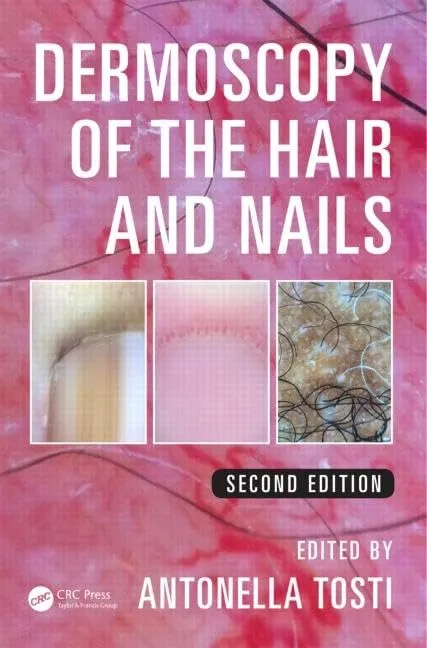 Dermoscopy of the Hair and Nails | 2nd Edition | Hardcover