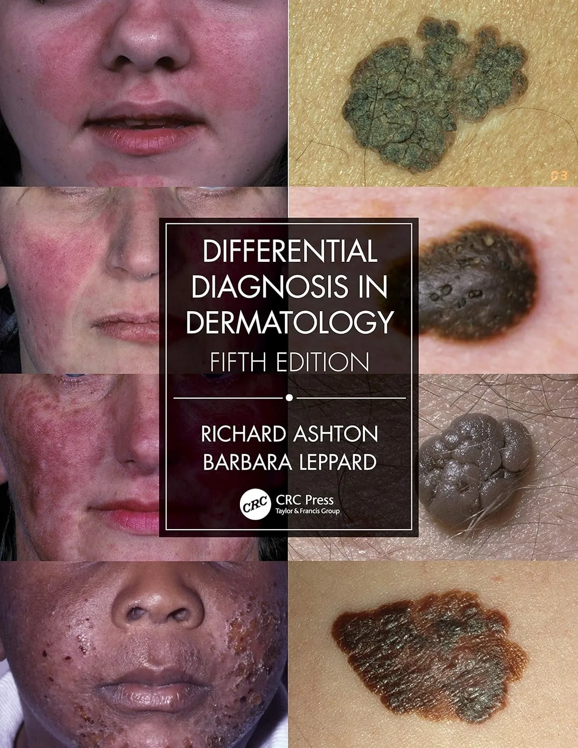 Differential Diagnosis In Dermatology | 5th Edition | Paperback