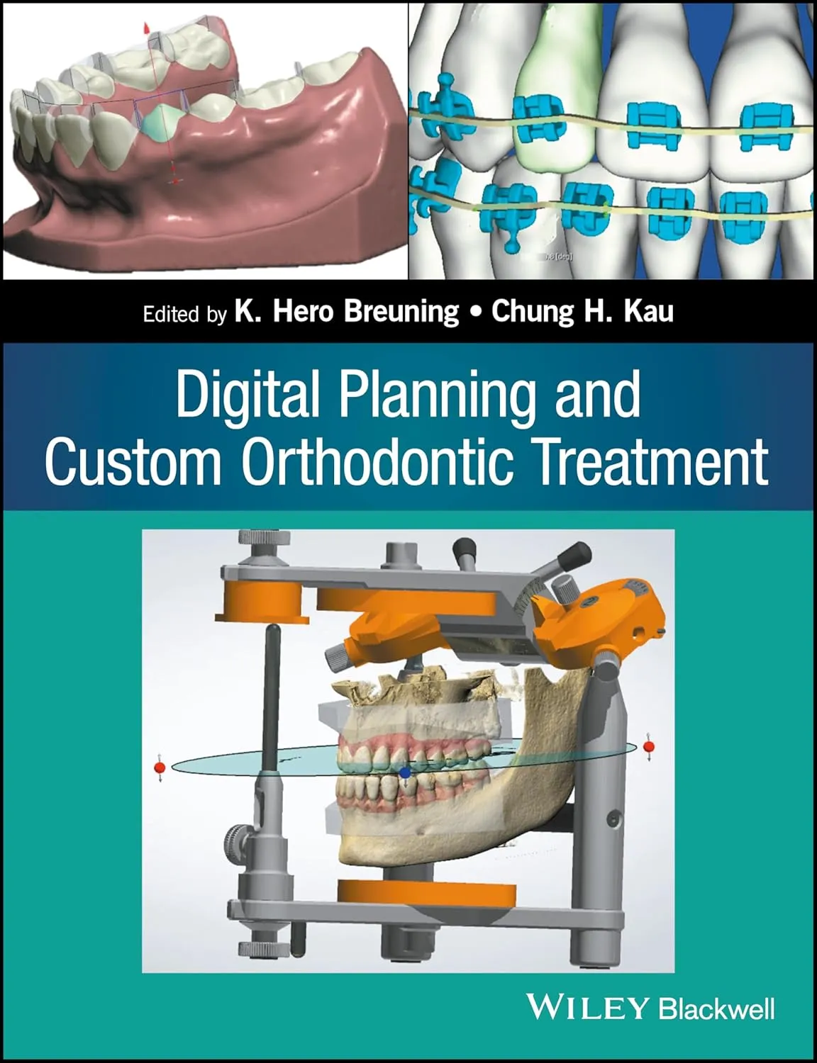 Digital Planning and Custom Orthodontic Treatment | Paperback