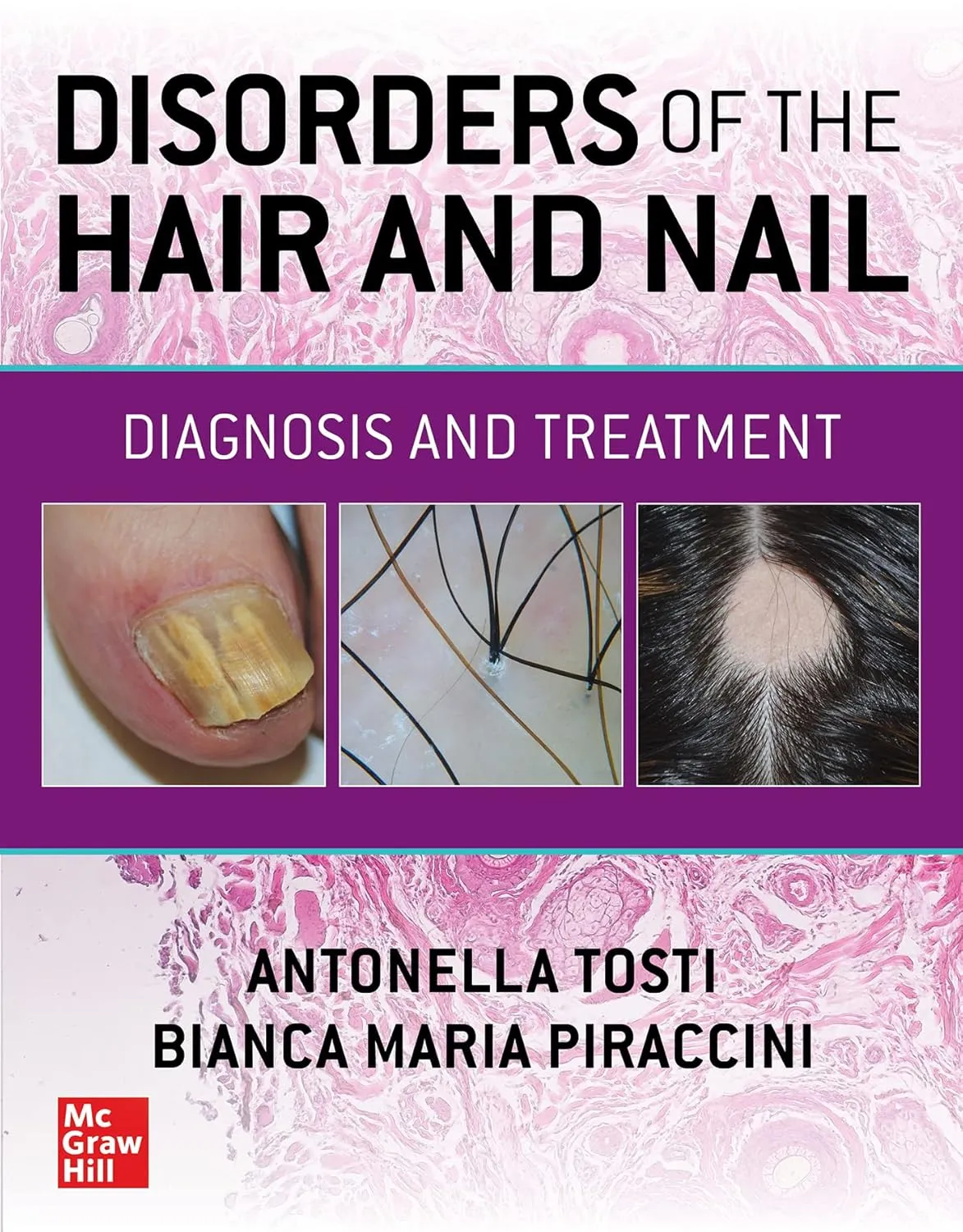 DISORDERS OF THE HAIR AND NAIL DIAGNOSIS AND TREATMENT | Hardcover