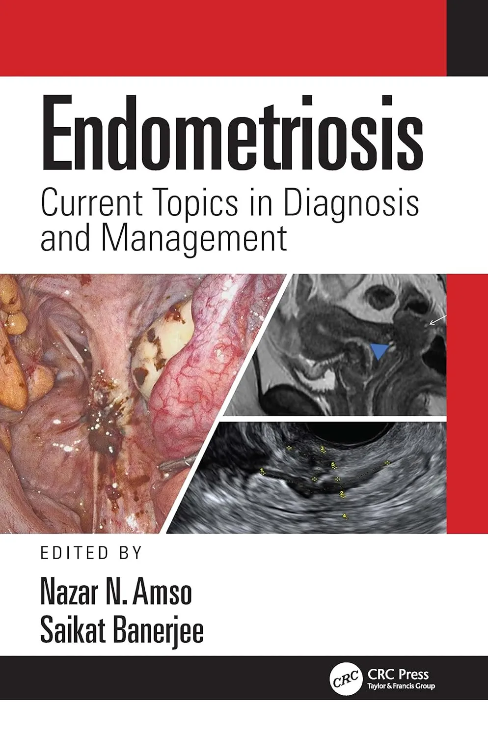 Endometriosis Current Topics In Diagnosis And Management | Hardcover