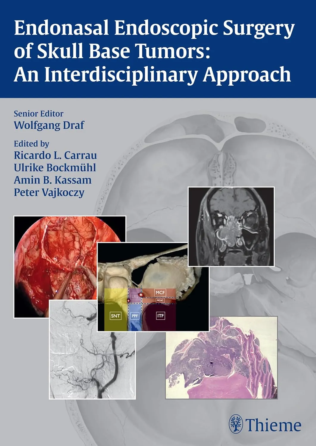 Endonasal Endoscopic Surgery of Skull Base Tumors An Interdisciplinary Approach | Hardcover