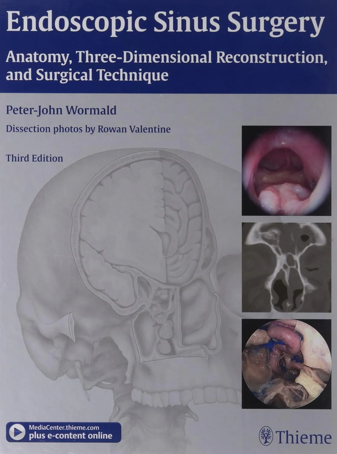 Endoscopic Sinus Surgery | Third Edition | Hardcover