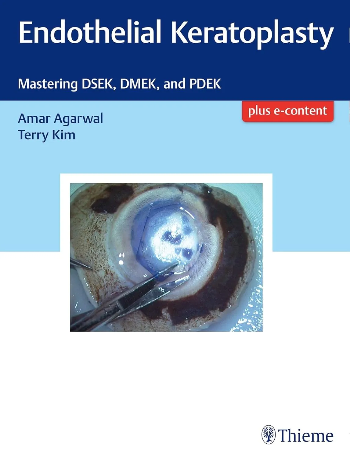 Endothelial Keratoplasty | Hardcover