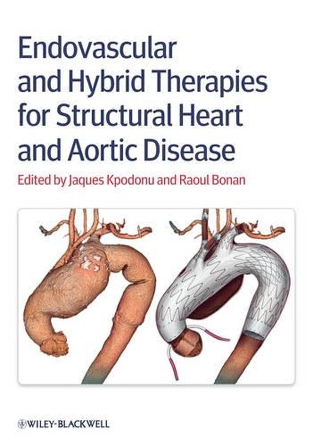 Endovascular and Hybrid Therapies for Structural Heart and Aortic Disease | Hardcover