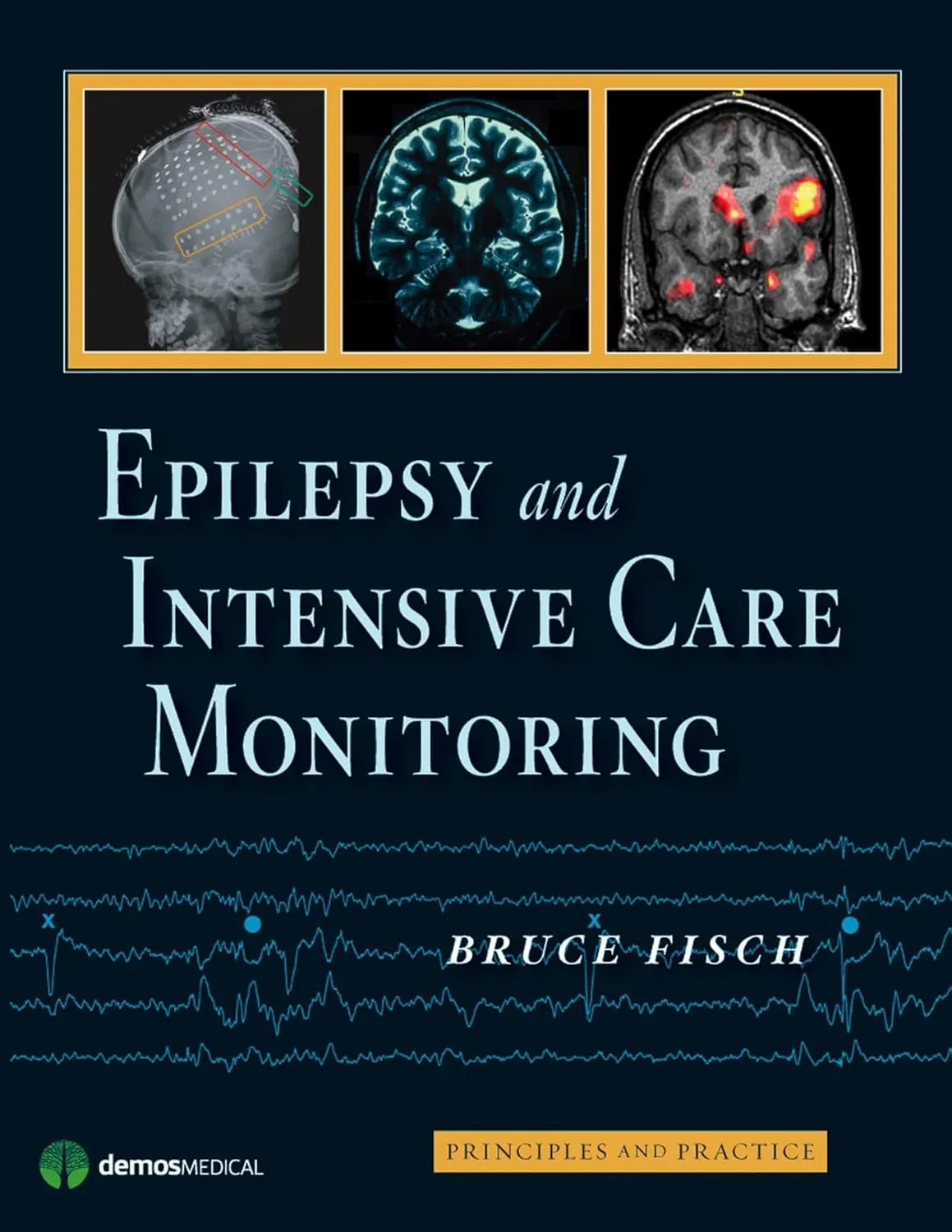 Epilepsy and Intensive Care Monitoring | Hardcover