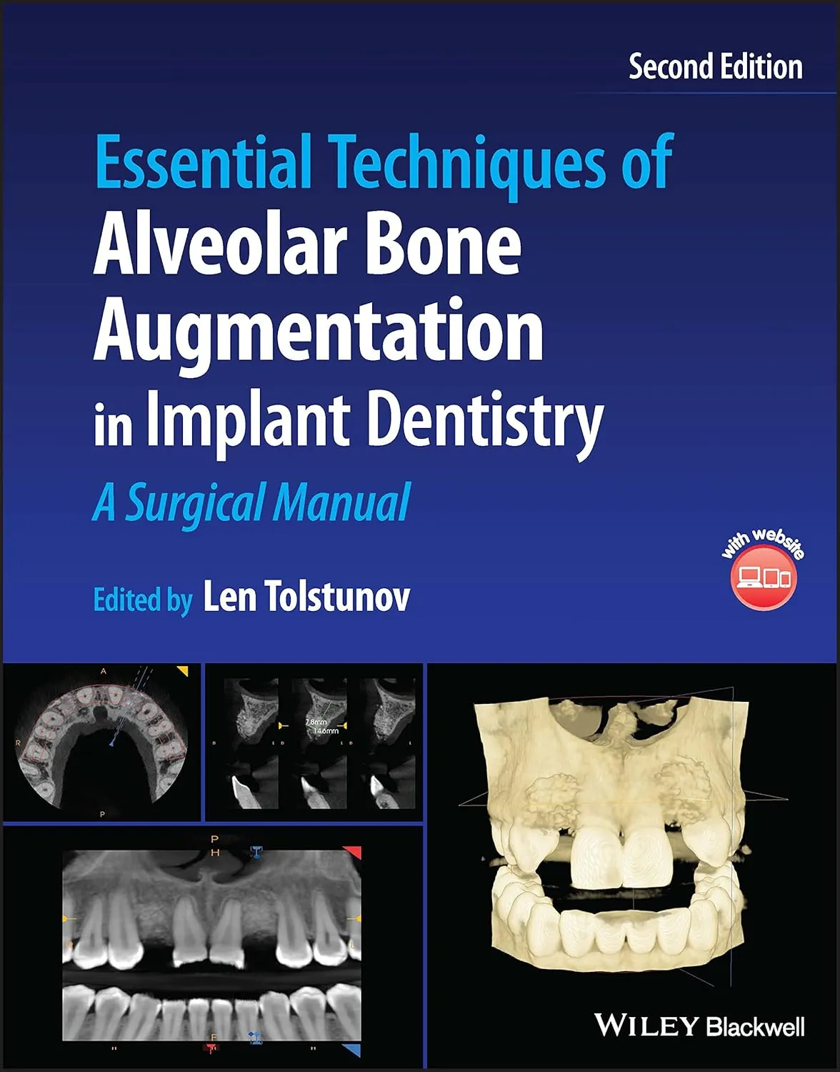 Essential Techniques Of Alveolar Bone Augmentation In Implant Dentistry A Surgical Manual 2nd Edition | Hardcover