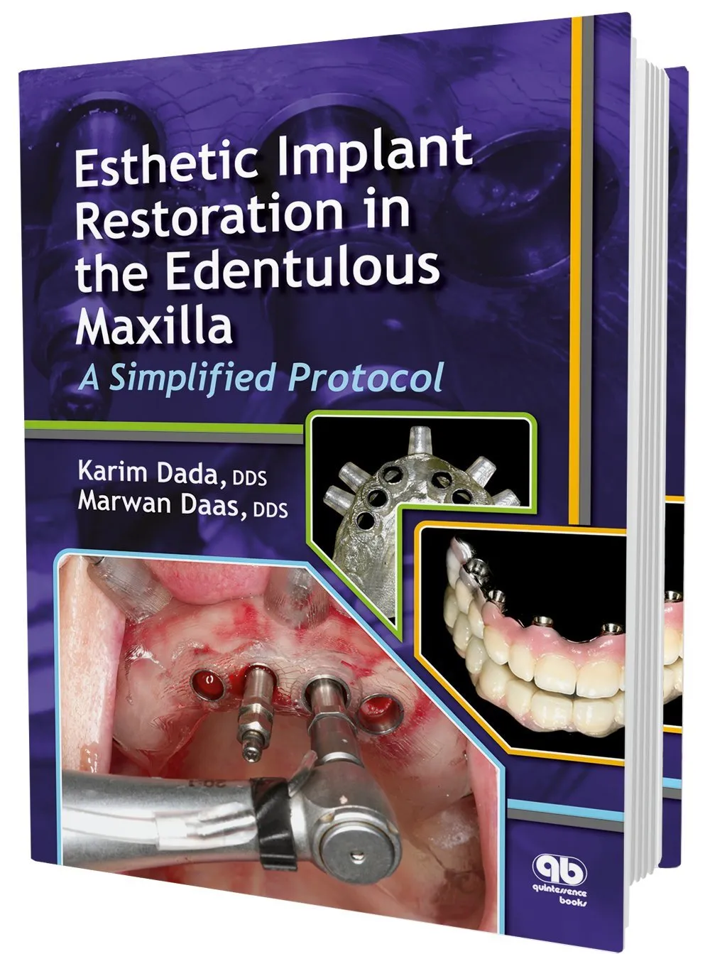 Esthetic Implant Restoration in the Edentulous Maxilla A Simplified Protocol | Hardcover