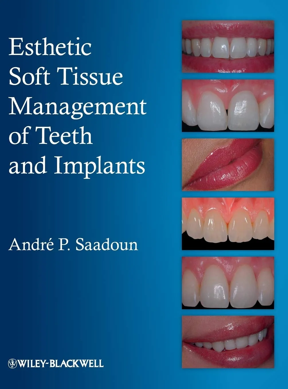 Esthetic Soft Tissue Management of Teeth and Implants | Hardcover