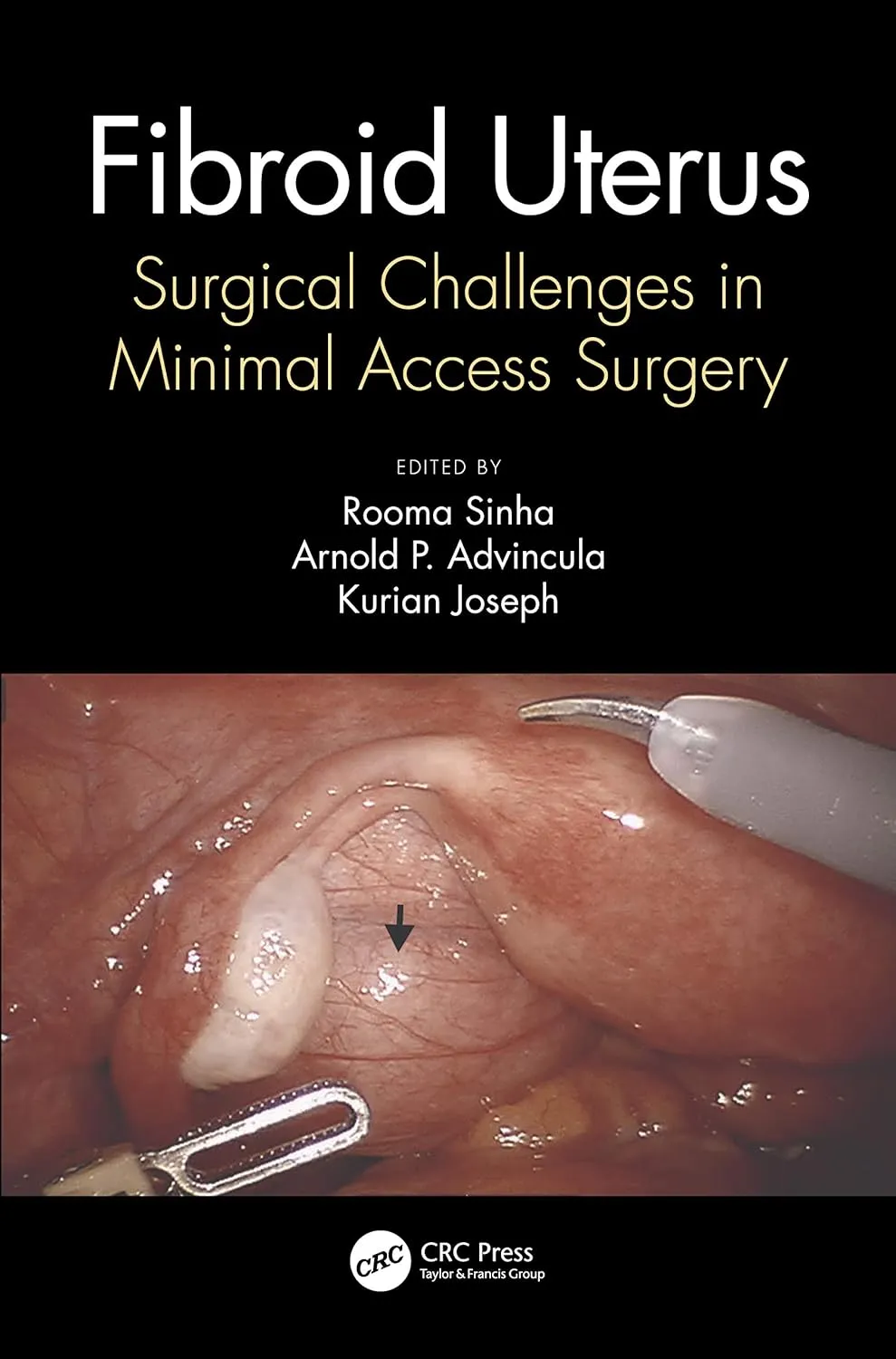 Fibroid Uterus Surgical Challenges In Minimal Access Surgery | Hardcover