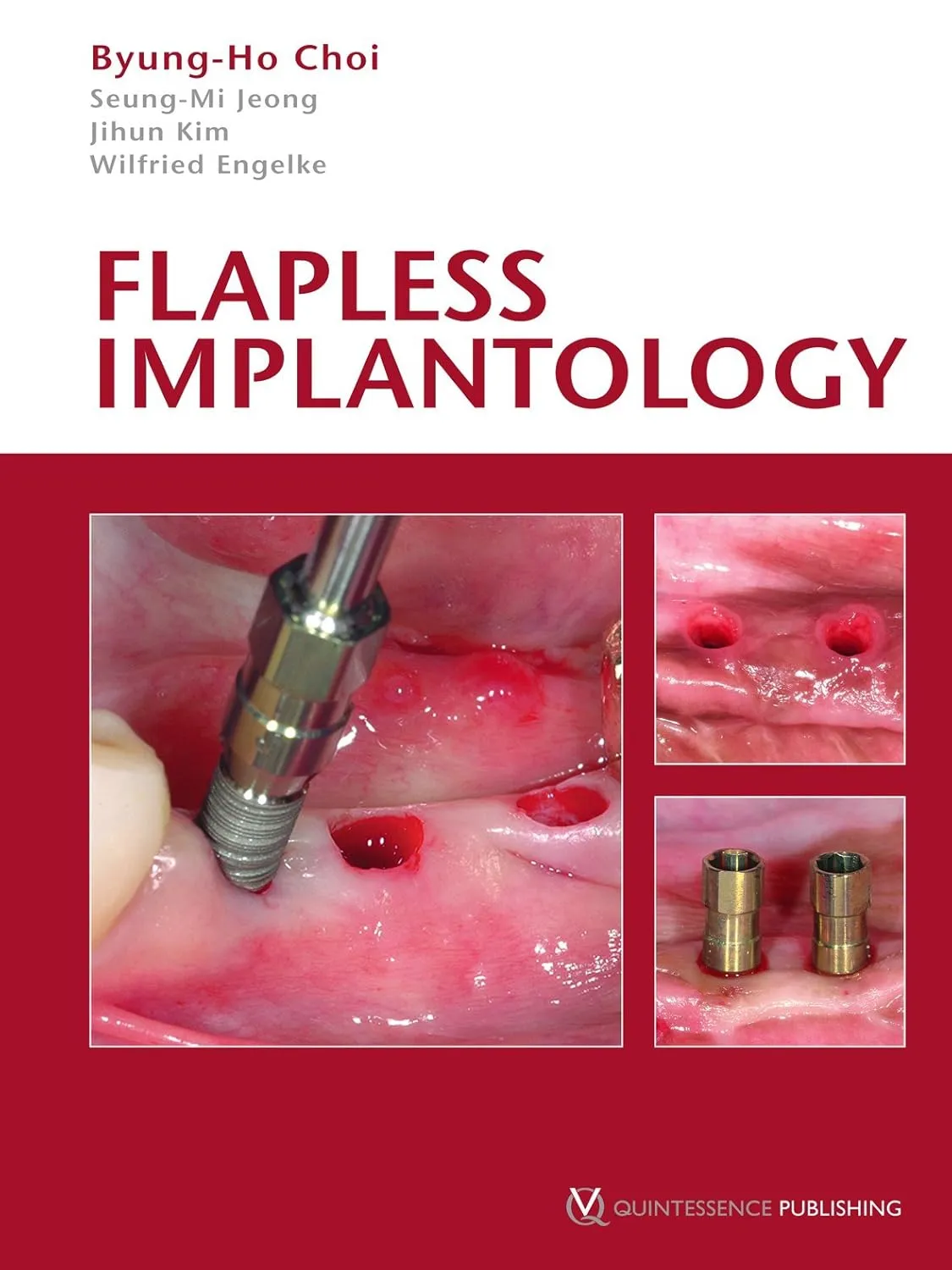 Flapless Implantology | Hardcover