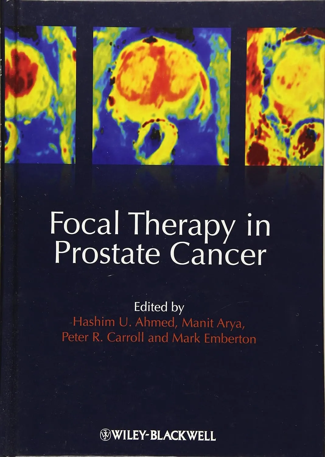 Focal Therapy in Prostate Cancer | Hardcover